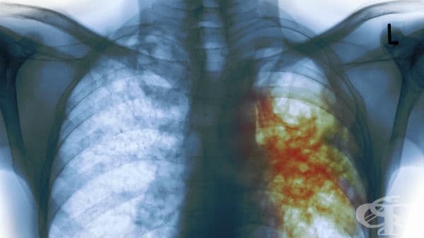 Д-р С. Денчева: Заради пандемията проспахме бум на туберкулозата